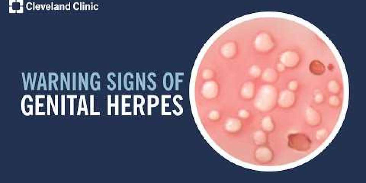 Genital Herpes Cure: Understanding HSV-2 and Treatment Options: